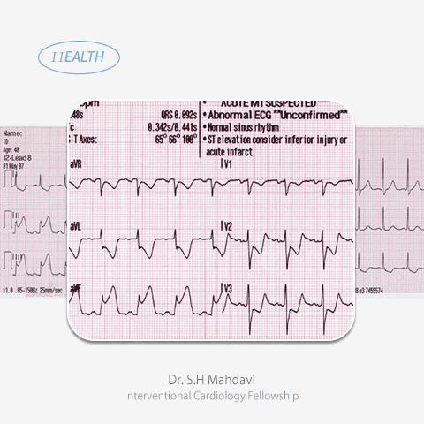 نوار قلب EKG